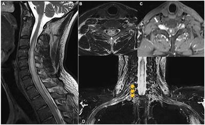 Case report: Myelitis and ganglionitis, an atypical presentation of Hansen’s disease